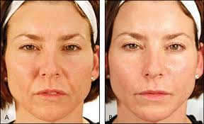 nasoloabial smile line fillers botox long island garden city